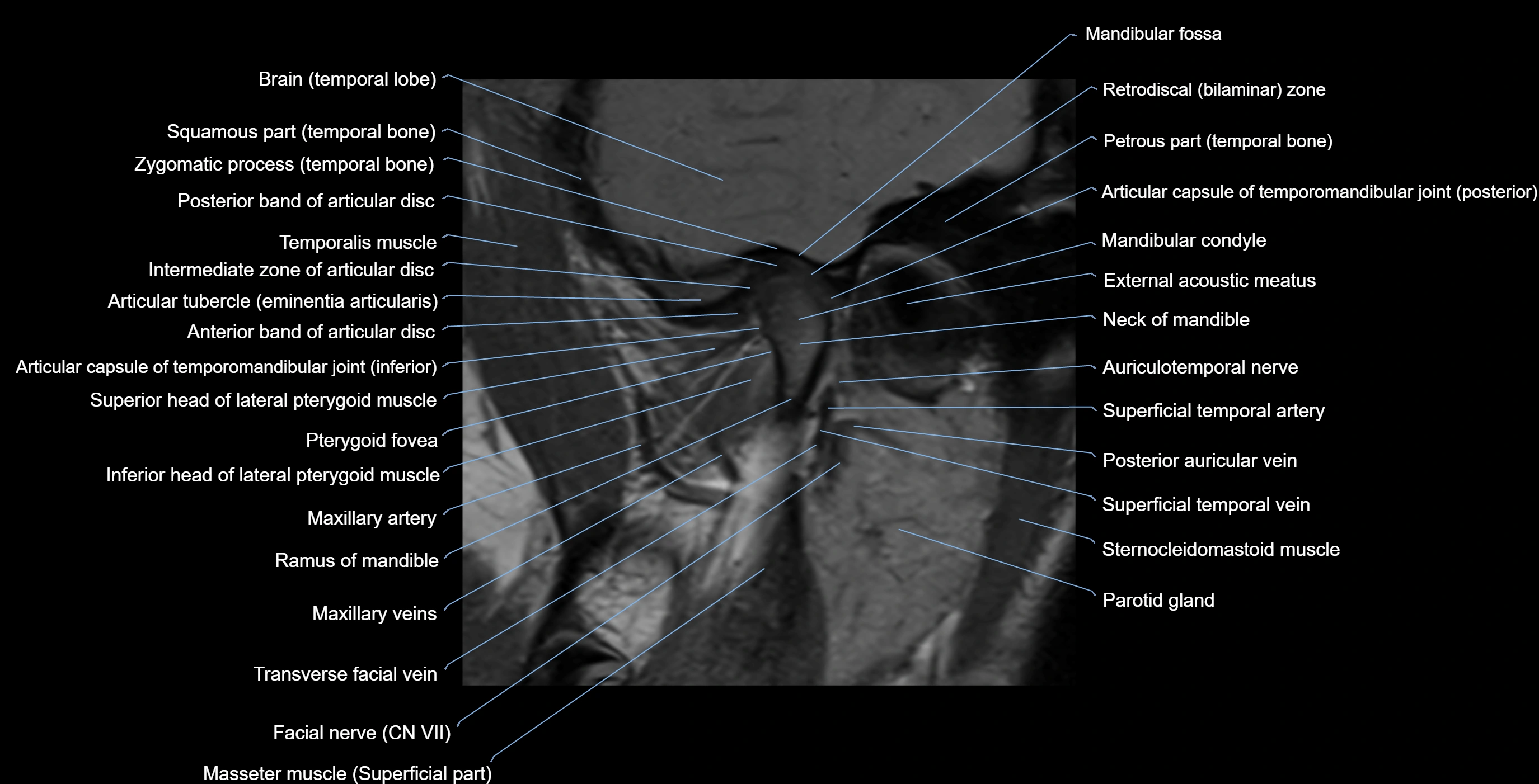 MRI TMJ sagittalclosed  mouth cross sectional 3T anatomy -img-00001-00008.webp